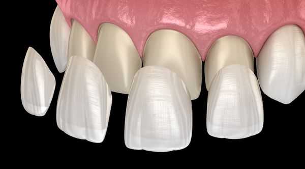 روش نصب روکش بر روی بخور مرکزی و برش دهنده جانبی تصویر دقیق دندان پزشکی 3D