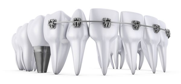 یک دندان با پرانتز و کاشت دندان 3 بعدی ارائه می شود