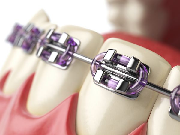 دندان ها را با بند یا براکت در دهان باز انسان قرار دهید مفهوم مراقبت از دندان تصویر سه بعدی