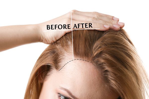 زن قبل و بعد از درمان ریزش مو بر روی زمینه سفید