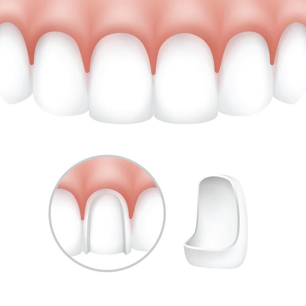 ونیرهای دندانپزشکی وکتور روی دندانهای انسانی که بر روی زمینه سفید جدا شده اند