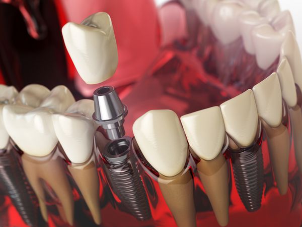 کاشت دندان در مدل دندان لثه و عاج دندان انسان است مفهوم دندانپزشکی پزشکی دندانپزشکی تصویر سه بعدی