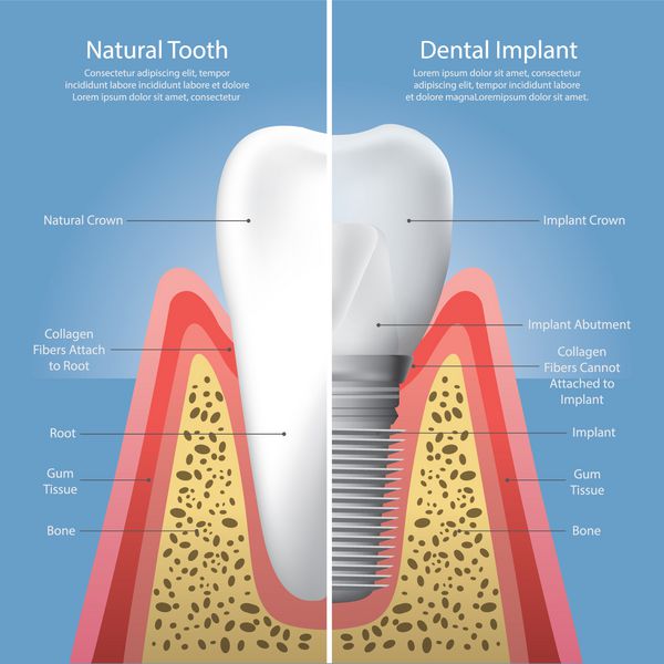 دندانهای انسانی و تصویر برداری ایمپلنت دندان