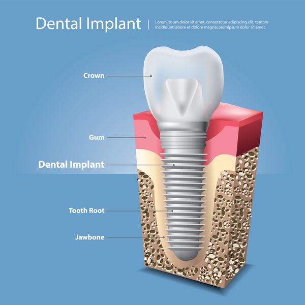 دندانهای انسانی و تصویر برداری ایمپلنت دندان