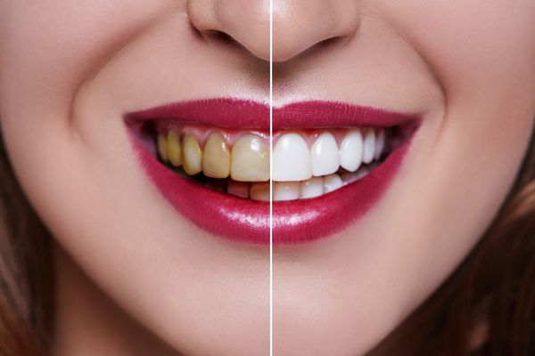 دندانهای زن قبل و بعد از درمان دندانپزشکی سفید کردن دندان ها زن خندان مفهوم بهداشت دندانپزشکی مراقبت از دهان ترمیم دندان دندانهای بد