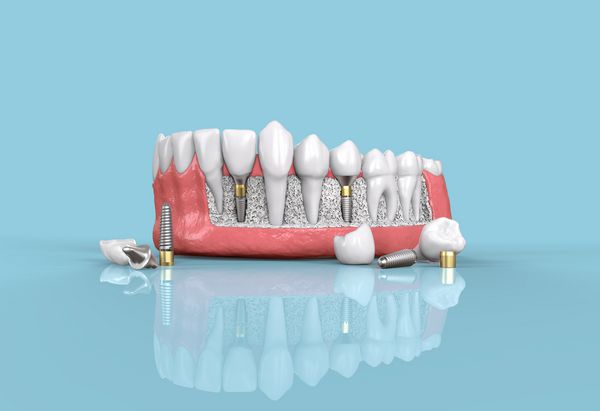 مدل کاشت دندان مدل 3 بعدی