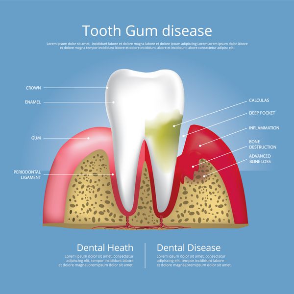 دندانهای انسانی مراحل تصویر برداری بیماری لثه