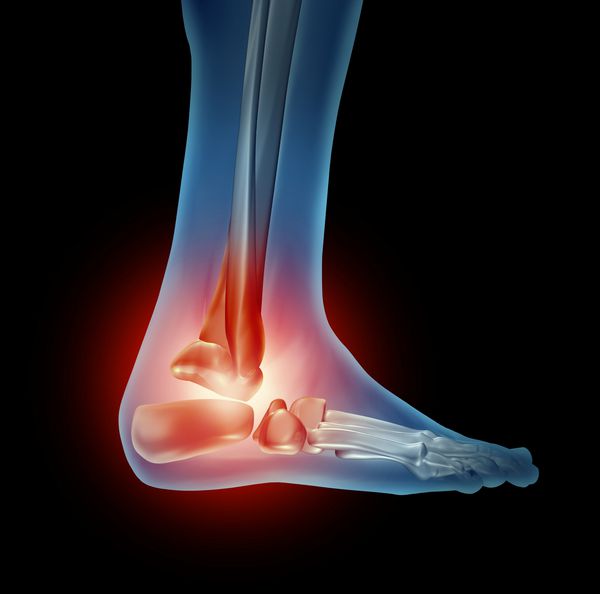 درد پا مچ پا با قسمت بدن اسکلت با استخوان های قرمز رنگ که در آن التهاب مفصل نمای جانبی وجود دارد که دارای یک آسیب مفصل ارتوپدی است که در اثر کفش های بد یا تصادف در حال اجرا ایجاد می شود