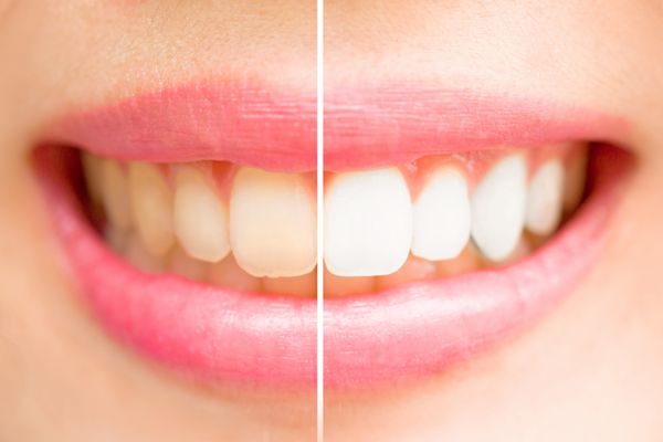 دندانهای کلوزآپ بین قبل و بعد از مسواک زدن زنانه می شوند