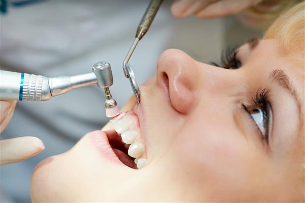 کلوزآپ روش دندانپزشکی پزشکی از جلا دادن دندان با تمیز کردن از رسوب دندان و ادنتولیت