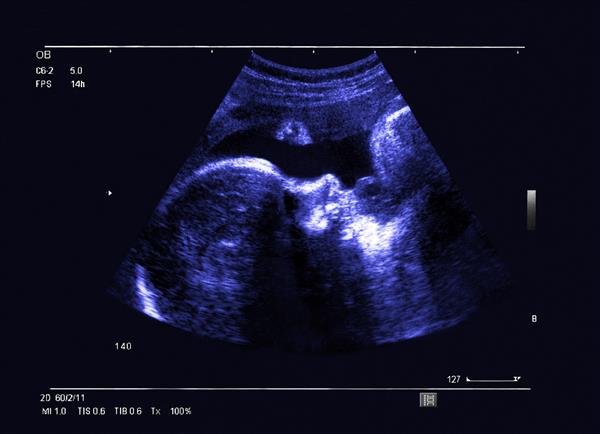 سونوگرافی جنین در هفته 32