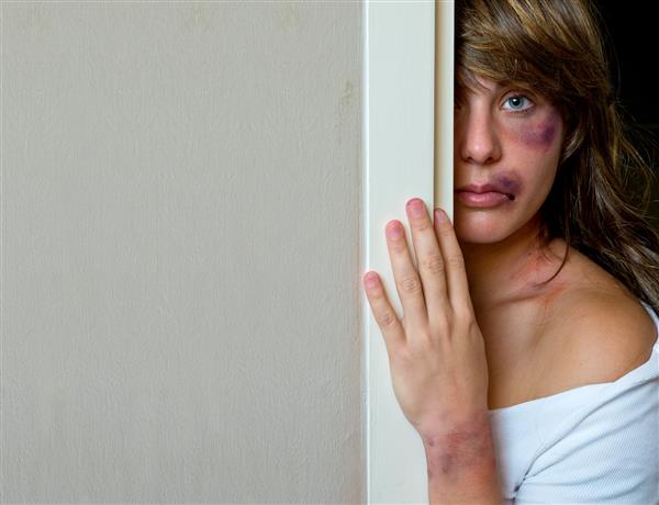 زنی که کبود شده است قربانی خشونت در خانواده یا تصادف در پشت دیوار مخفی شده است