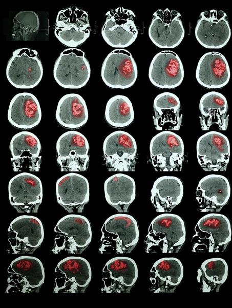 اسکن مغز با سکته مغزی خونریزی دهنده اطلاعات آموزش حرفه ای قرمز منطقه آسیب دیده را برجسته می کند