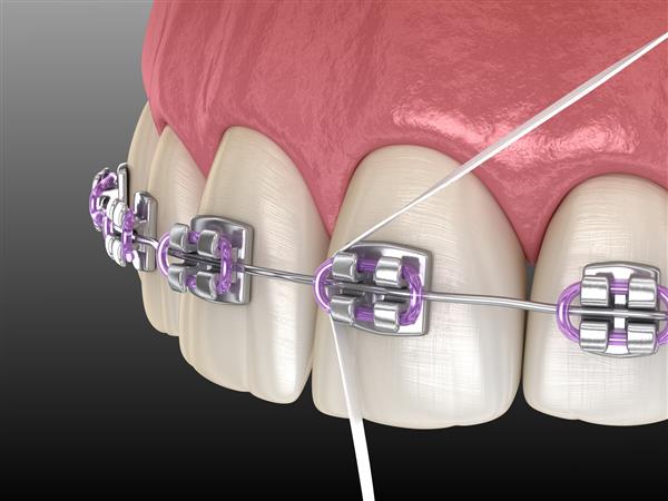 فرآیند بریس های تمیز کردن نخ دندان تصویر بهداشتی و دقیق سه بعدی از نظر پزشکی