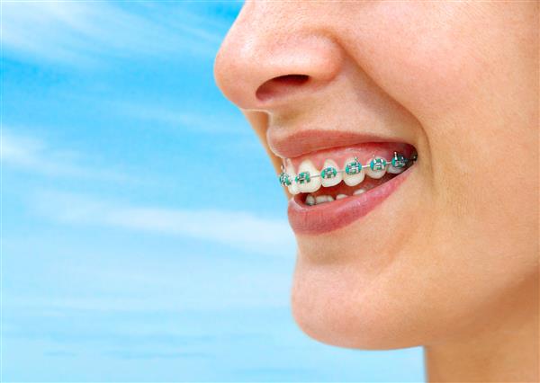 جزئیات لبخند زن جوان که دندان های سفید را با بریس نشان می دهد