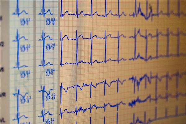 نمودار ECG