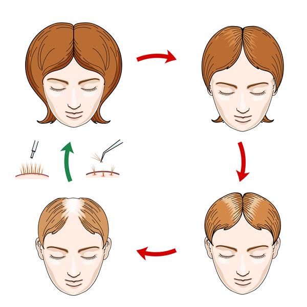 نمادهای ریزش مو و کاشت مو در زنان ریزش مو زن مراقبت از مو سر سر انسان سر موهای رویش تصویر برداری