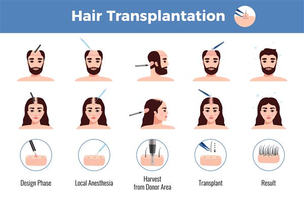 کاشت مو برای مردان و زنان با مراحل عمل اینفوگرافیک روی سفید
