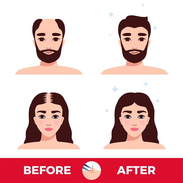 زن و مرد قبل و بعد از کاشت مو با رنگ سفید