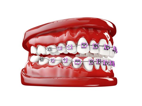دندان با براکت مفهوم مراقبت از دندان تصویر سه بعدی