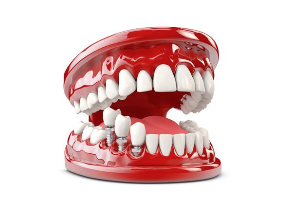 ایمپلنت انسان دندان تصویر سه بعدی مفهومی دندان