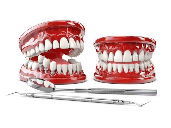 ایمپلنت انسان دندان تصویر سه بعدی مفهوم دندان