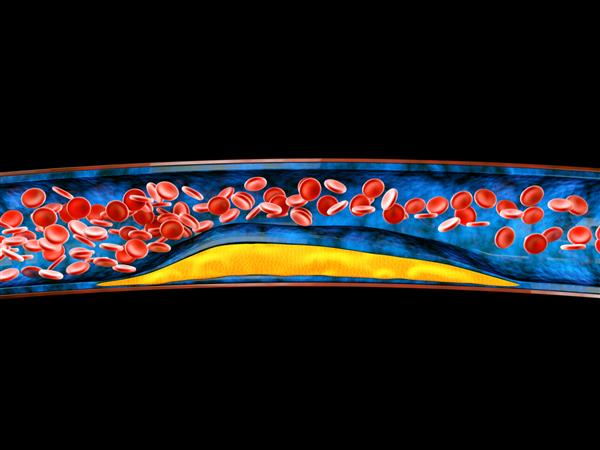 تصویر سه بعدی از سلول های خونی با تجمع پلاک کلسترول