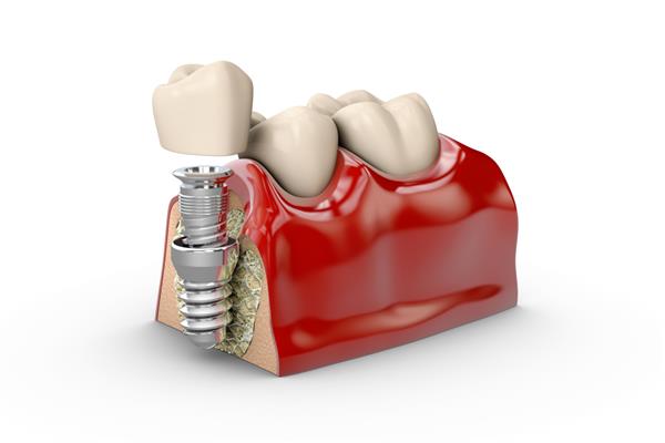 تصویر سه بعدی از مدل ایمپلنت دندان