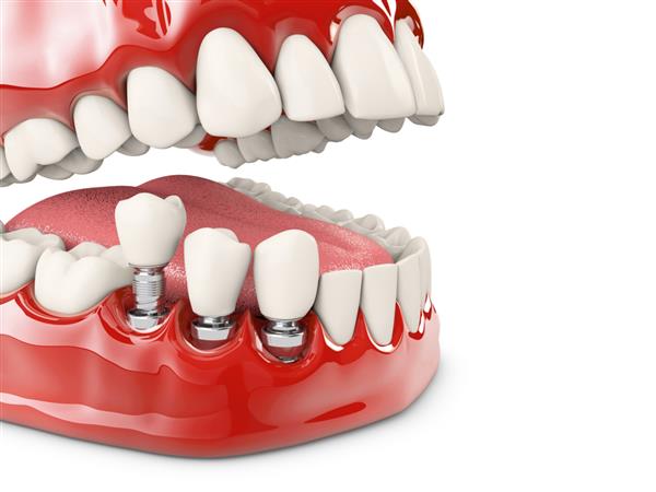 دندان انسان و ایمپلنت دندان تصویر سه بعدی
