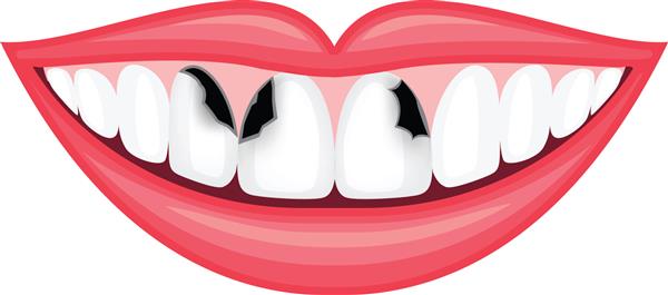 پوسیدگی دندان دندان های ناسالم دهان انسان مفهوم مراقبت از دندان تصویر جدا شده در پس زمینه سفید