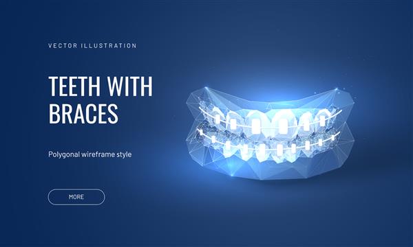 تصویر وکتور بریس های دندانی به سبک چند ضلعی آینده نگر درمان ارتودنسی دندان برای بهبود بایت