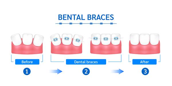 مد سبک درمان ارتودنسی آبی زیبا قبل و بعد دندان های سفید با براکت های فلزی بریس های دندانی جدا شده روی پس زمینه سفید وکتور سه بعدی واقعی مفهوم بهداشت مراقبت از دندان