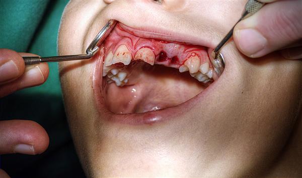 کودک در دندانپزشکی