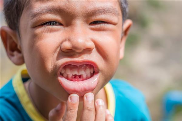 پسر کوچک آسیایی شاد که لبخند می زند و دندان های از دست رفته خود را نشان می دهد پسر بچه ناز اولین دندان شیری را از دست داد کودک در حال نشان دادن دندان شیری که افتاده است