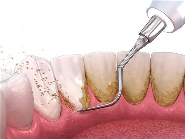 بهداشت دهان جرم گیری و پلانینگ ریشه درمان پریودنتال معمولی تصویر سه بعدی دقیق پزشکی از درمان دندان انسان