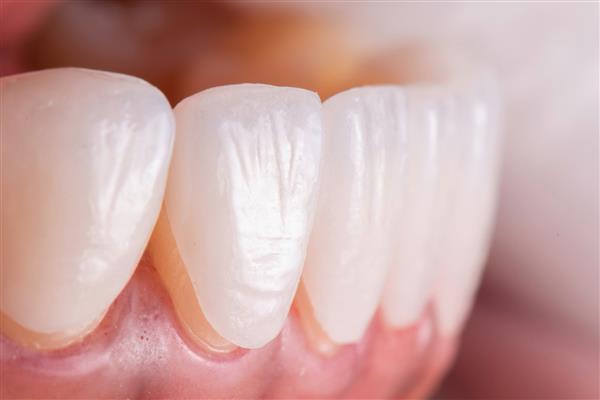 قبل از نصب روکش های سرامیکی دندان را برای دندان های پایینی امتحان کنید روکش های لمینت شده چینی برای سفید کردن و اصلاح لبخند