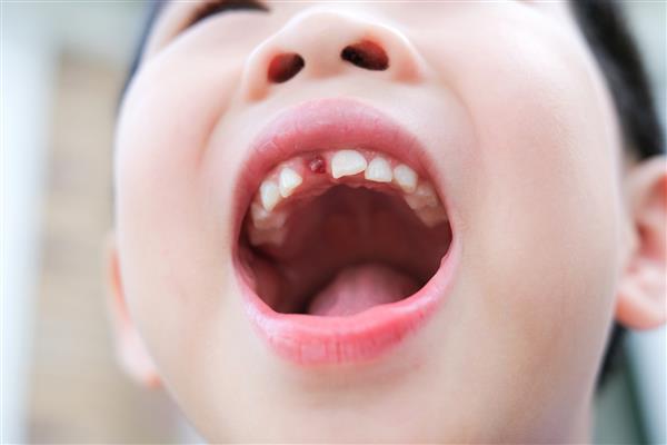 نمای نزدیک دندان های از دست رفته در دهان پسر جوان آسیایی 6 ساله دندان های شیری جلوی بالایی خود را از دست داده است دهانش را باز می کند و زیر نور خورشید در باغ می ایستد مفهوم سلامت و خانواده