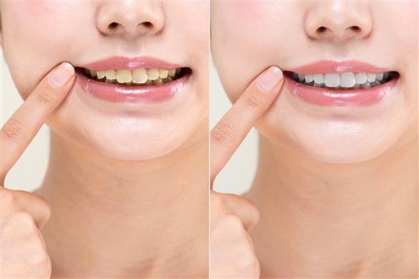 مقایسه دندان های سفید و زرد زنانه
