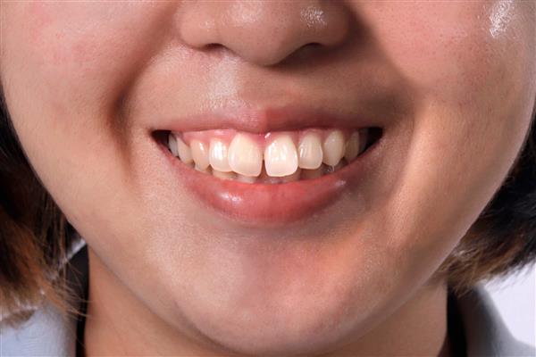 یک زن آسیایی از نزدیک با دندان های شکل خندان باعث می شود که دندان های نامناسب یا بد به نظر برسد