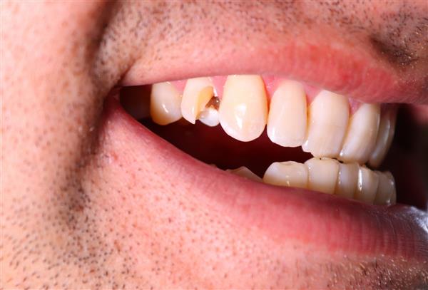 دندان تراشیده دندانی است که شکسته است ممکن است یک قطعه کوچک یا بزرگ در اثر زمین خوردن آسیب ورزشی یا آسیب های دیگر به دهان از جمله گاز گرفتن چیزی سخت از بین رفته باشد