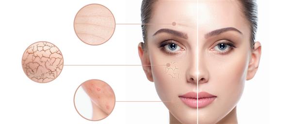 نمای نزدیک صورت زن مشکلات پوستی را نشان می دهد خشکی پوست آکنه چین و چروک و سایر عیوب جوانسازی آبرسانی و درمان پوست