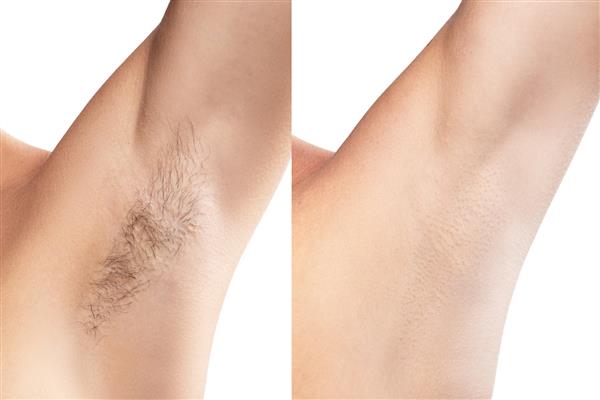 مقایسه زیر بغل زنان پس از درمان موهای زائد
