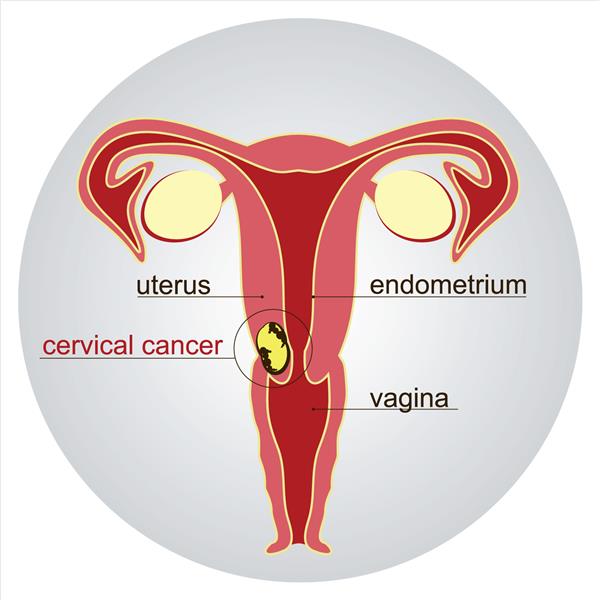 سرطان دهانه رحم تصویر شماتیک تصویر برداری