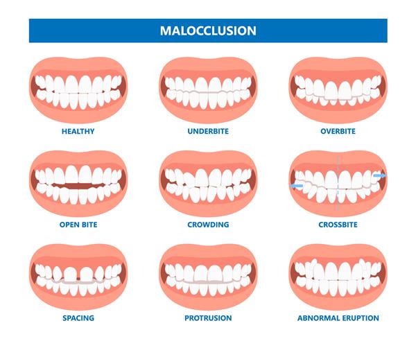 دهان باز عمیق دندان بایت بد لثه درد مفصل جراحی فک استخوان اصلاحی لبخند دهانی پایین تر ضعیف سلامت چانه اضافی فاصله قدامی ثابت