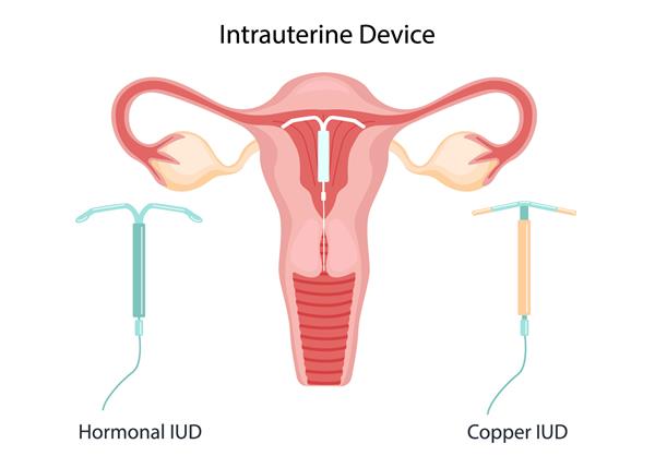 روش پیشگیری از بارداری IUD جدا نیست کنترل و محافظت از بارداری وسیله داخل رحمی تصویر برداری به سبک مسطح