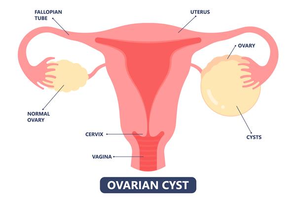 سرطان تخمدان PCOS لگن درد اندو شکم تورم رحم کیست تخمدان سنگین بررسی جراحی برداشتن حاملگی لوله شکم دوره چرخه مشکل باروری تشخیص قاعدگی سلولی پولیپ گردن رحم