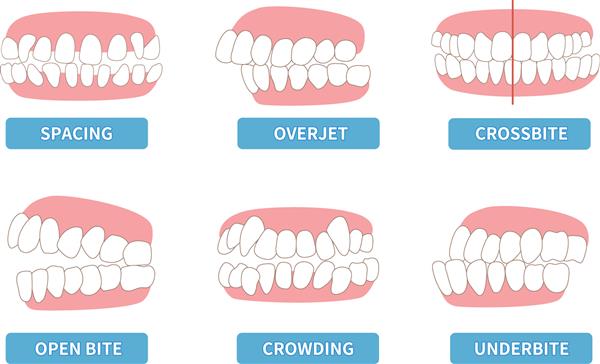 لیست دندان هایی که نیاز به درمان دارند شلوغی اکلوژن مخالف اپن بایت بیرون زدگی قدامی فک بالا حفره دندان