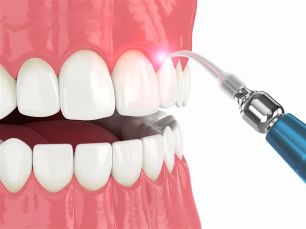 رندر سه بعدی لیزر دایود دندان که برای درمان لثه استفاده می شود مفهوم استفاده از لیزر درمانی در درمان لثه