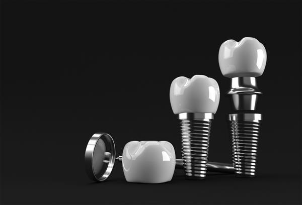 مفهوم جراحی ایمپلنت دندان رندر سه بعدی