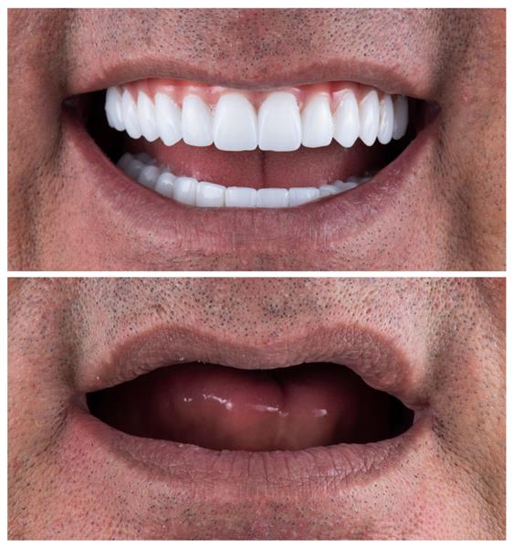 عکاسی شغلی دندانپزشکی کاشت روکش تاج دندان